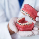 Closeup of braces on a 3D model of teeth