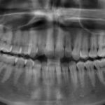 Black and white panoramic X-ray showing a patient with 4 wisdom teeth that need to be removed