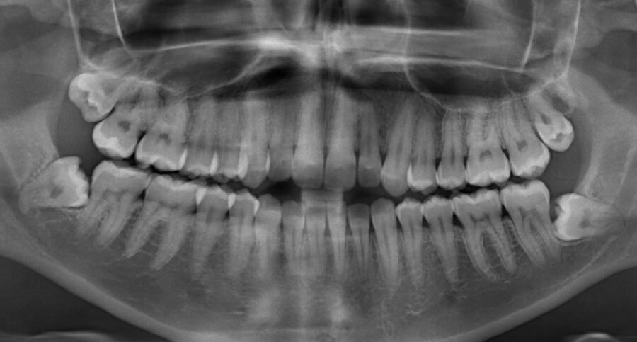 Black and white panoramic X-ray showing a patient with 4 wisdom teeth that need to be removed