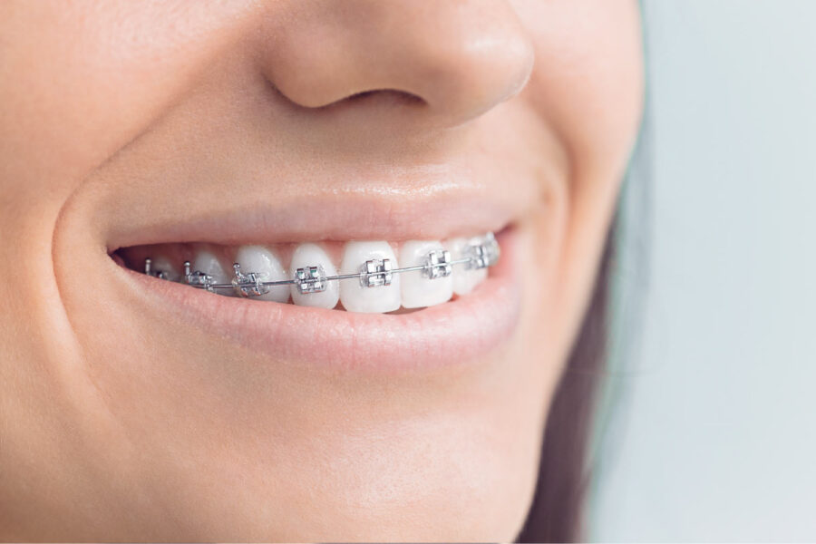 Closeup of a woman's teeth with metal braces to straighten her teeth in Houston, TX