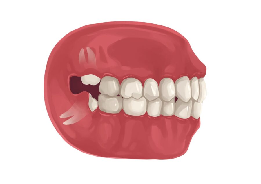 Illustration of problematic wisdom teeth that need to be removed