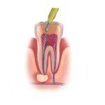 Illustration of a tooth undergoing root canal therapy