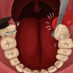 Illustration of wisdom teeth (teeth with glasses and graduation hats that make them look wise) being removed from a mouth